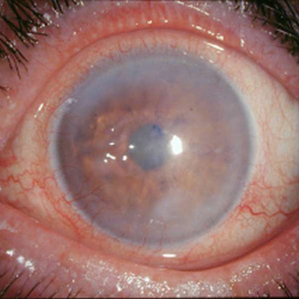 глаз с буллезной кератопатией